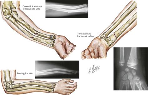 Common Fractures Clinical Gate