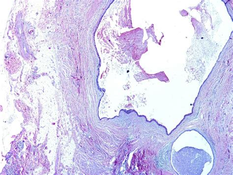 Cyst Filled With Mucinous Material H E ×20 Download Scientific Diagram