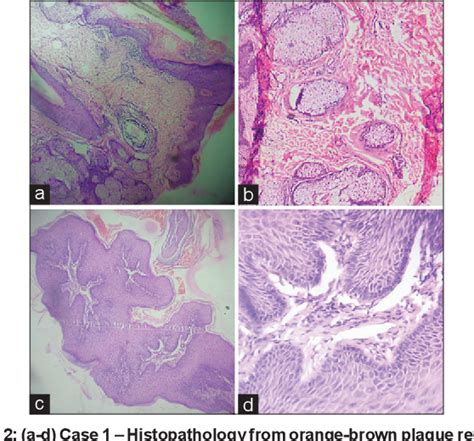 Figure 2 From Occurrence Of Filiform Wart Over Nevus Sebaceous A