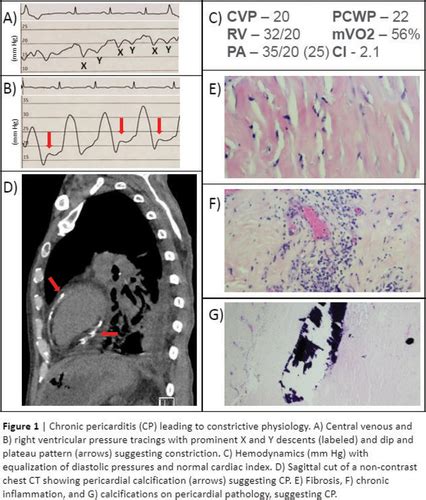 Constrictive Pericarditis Masquerading As Cirrhosis Journal Of The