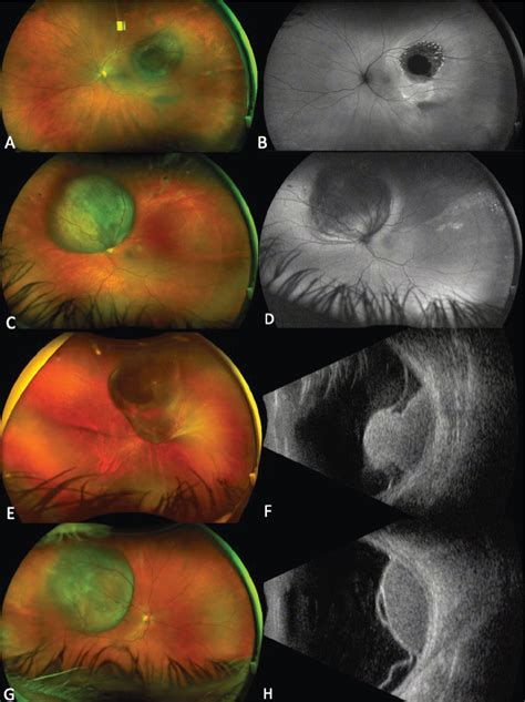 Chorioretinal Lesions