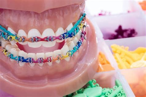 Dental Braces Colors Cute Braces Colors Power Chain Braces Rainbow