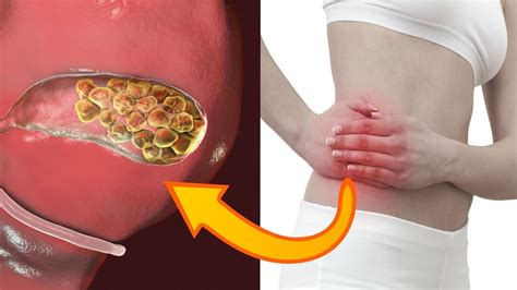 How To Get Rid Of Gallstones Naturally Without Surgery 7 Home