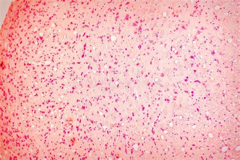 Tissue Slice Biopsy To Check For A Malignant Tumor View In A