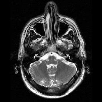 MRI Images - Brain MRI Images Axial T2 - MR-TIP.com