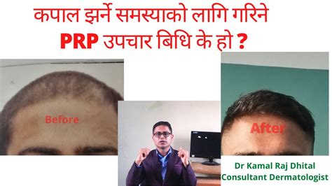 Prp Treatment For Hair Loss In Nepal By Dermatologist Dr Kamal Raj