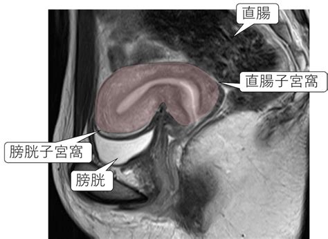 子宮頸部のmri画像における正常解剖