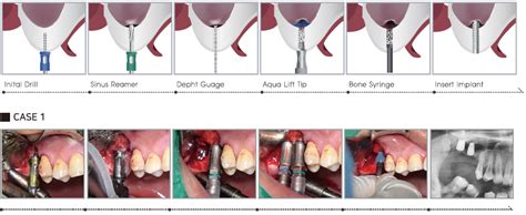 Sinus Crestal Approach Kit Dental Studio