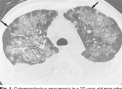 Figure 1 From Cytomegalovirus Pneumonia High Resolution Ct Findings In Ten Non Aids