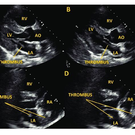 Transthoracic Echocardiography Panel A B Parasternal Long Axis View Download Scientific