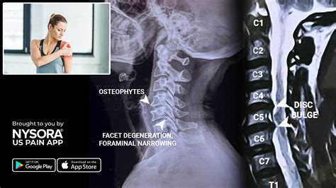 Case Study Cervical Radiculopathy Injection Nysora