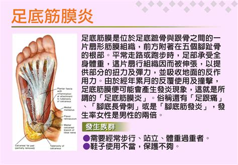 衛教 足底筋膜炎 熱河診所｜骨科、醫美、植髪