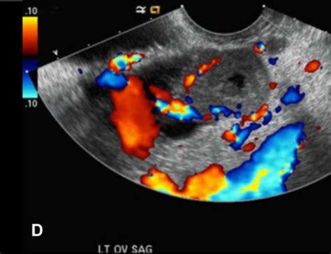 Color Doppler Transvaginal Imaging Through The Left Ova Open I