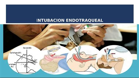 Intubación endotraqueal esthela perdomo uDocz