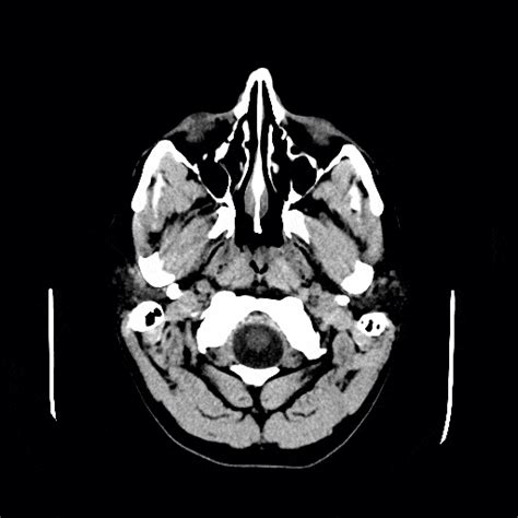 Ct Scans Interpretation Principles Basics Teachmeanatomy