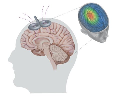 Estimulação Magnética Transcraniana Na Doença De Parkinson