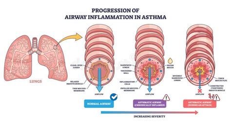 Airway Inflammation Progression in Asthma Shows Normal To Attack Stages ...