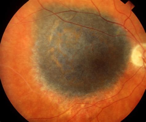 Choroidal Melanoma Of The Eye