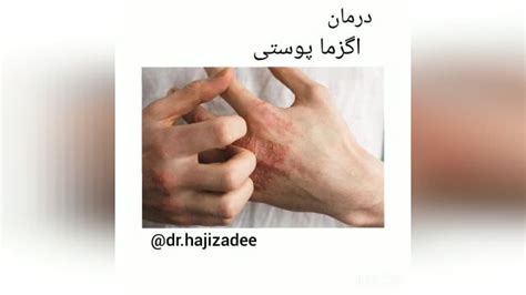 اگزما پوستی چیست؟ علائم، علت، تشخیص و درمان اگزما در طب سنتی