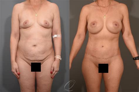 Mommy Makeover Before After Photos Patient Serving Rochester