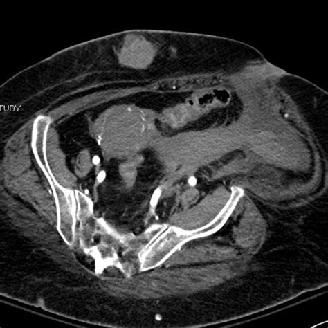 Left External Iliac Artery Pseudoaneurysm With Active Extravasation And