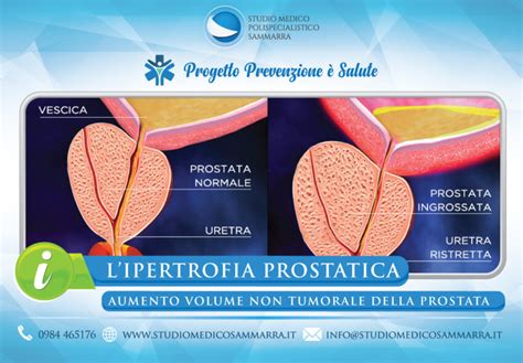 Ipertrofia Prostatica A Cosenza E Rende Studio Medico Sammarra