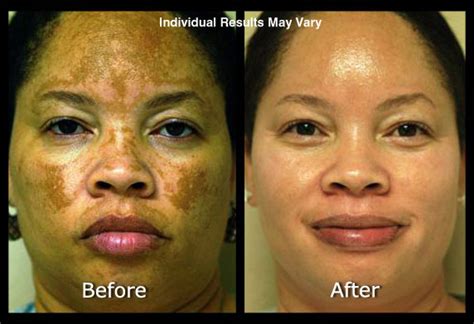 Hyperpigmentation On Face Treatment - Doctor Heck