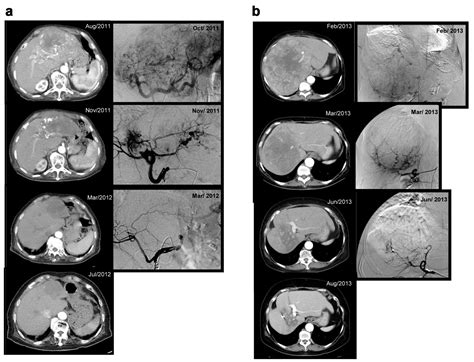 Sorafenib And Hepatic Arterial Infusion Chemotherapy For Advanced