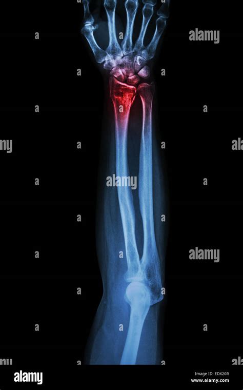 Fracture Distal Radius Wrist Bone Colles Fracture Stock Photo Alamy