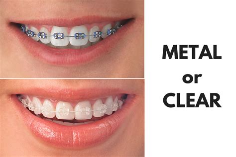 Invisalign Vs Ceramic Braces