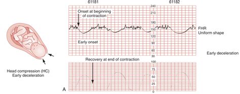 Crackcast E180 Labor And Delivery Canadiem