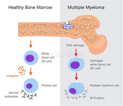 Multiple Myeloma Diagram Stock Vector Illustration Of Cancer