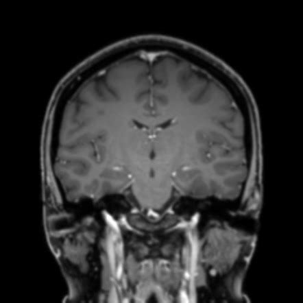 Normal Mri Internal Auditory Canal Image Radiopaedia Org