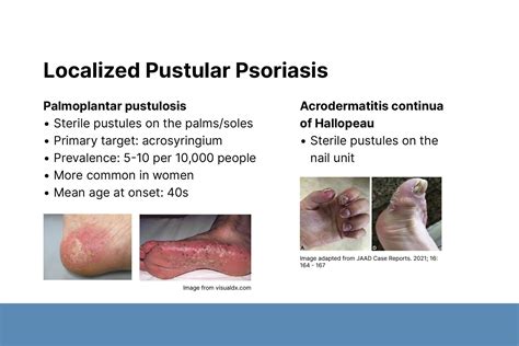 Updates In Pustular Psoriasis Dermatology Focus