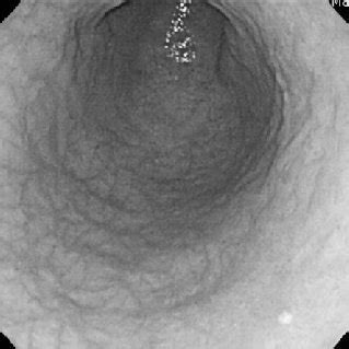 (PDF) Gastric and colonic ulcers induced by a nonsteroidal anti ...