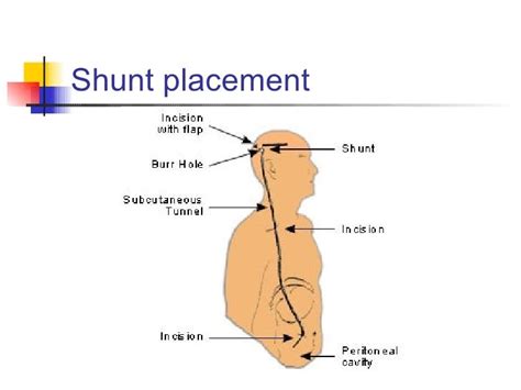 Normal Pressure Hydrocephalus