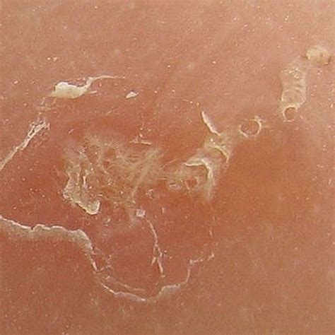 Albums 105 Pictures What Do Scabies Bites Look Like Pictures Updated