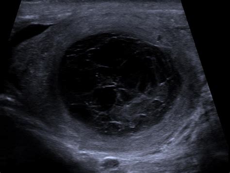 Epididymal Haematoma Multiparametric Ultrasonographic Findings Eurorad