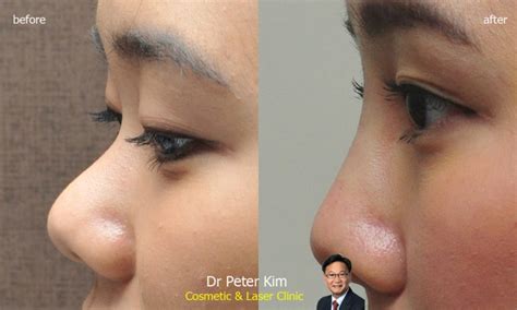 Laser Pore Reduction Dr Peter Kim Cosmetic Laser Clinic