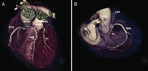 Ct Coronary Angiogram 3d Reconstruction Showing A Single Coronary