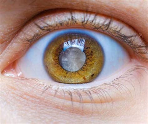 Glaucoma For Eyes 11 Eye Opening Facts You Need To Know About Glaucoma Vijaya Nethralaya