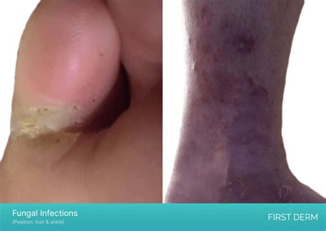 Chronic Itch Onfoot In Same Spot Sale Emergencydentistry