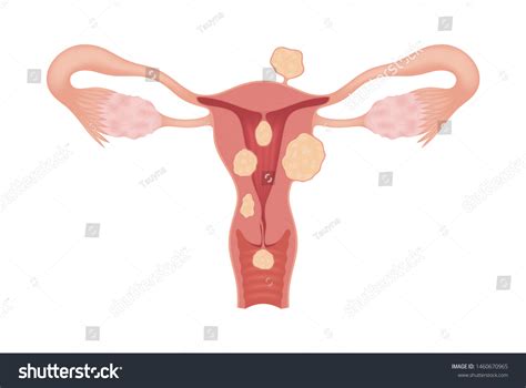 316 Myoma Of The Uterus Images Stock Photos Vectors Shutterstock