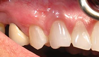 Before And After Gallery Coastal Periodontics