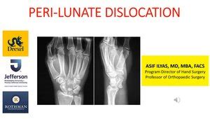 Peri-Lunate Dislocation Repair | VuMedi