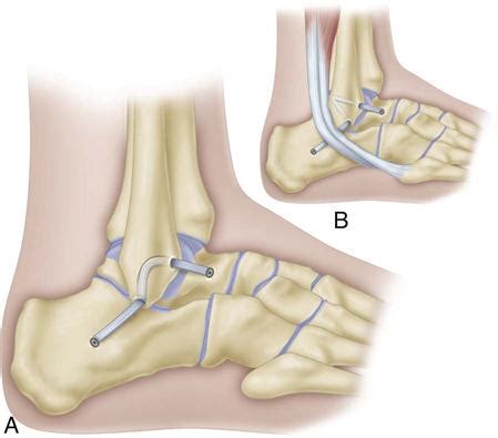 Lateral Ligament Repair Of The Ankle Clinical Gate