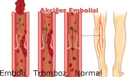 Akciğer embolisi nedir tedavisi Derin ven trombozu akciğer embolisi