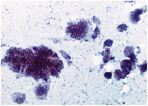 Giant Cell Tumor Of Soft Tissue FNA Cytopathology Of 4 Cases Review