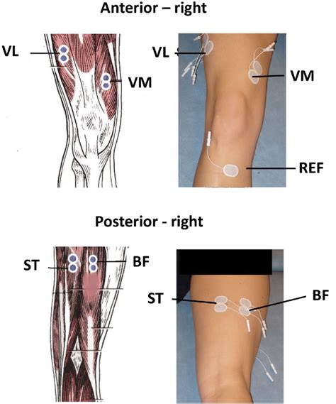 Surface Electromyography Emg Electrode Placements Of The Quadriceps