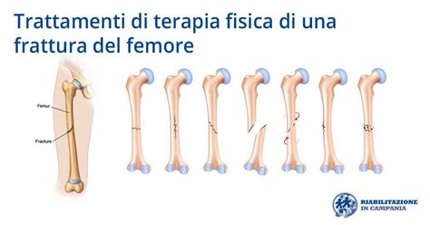 Trattamenti Di Terapia Fisica Di Una Frattura Del Femore